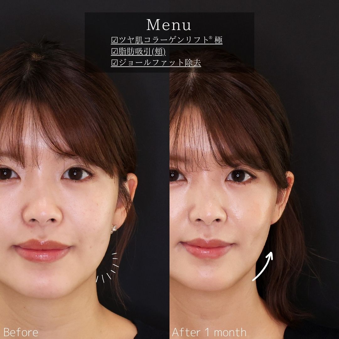 TAC式 ツヤ肌コラーゲンリフト®/顔の脂肪吸引/ジョールファット除去の症例写真 施術前後 