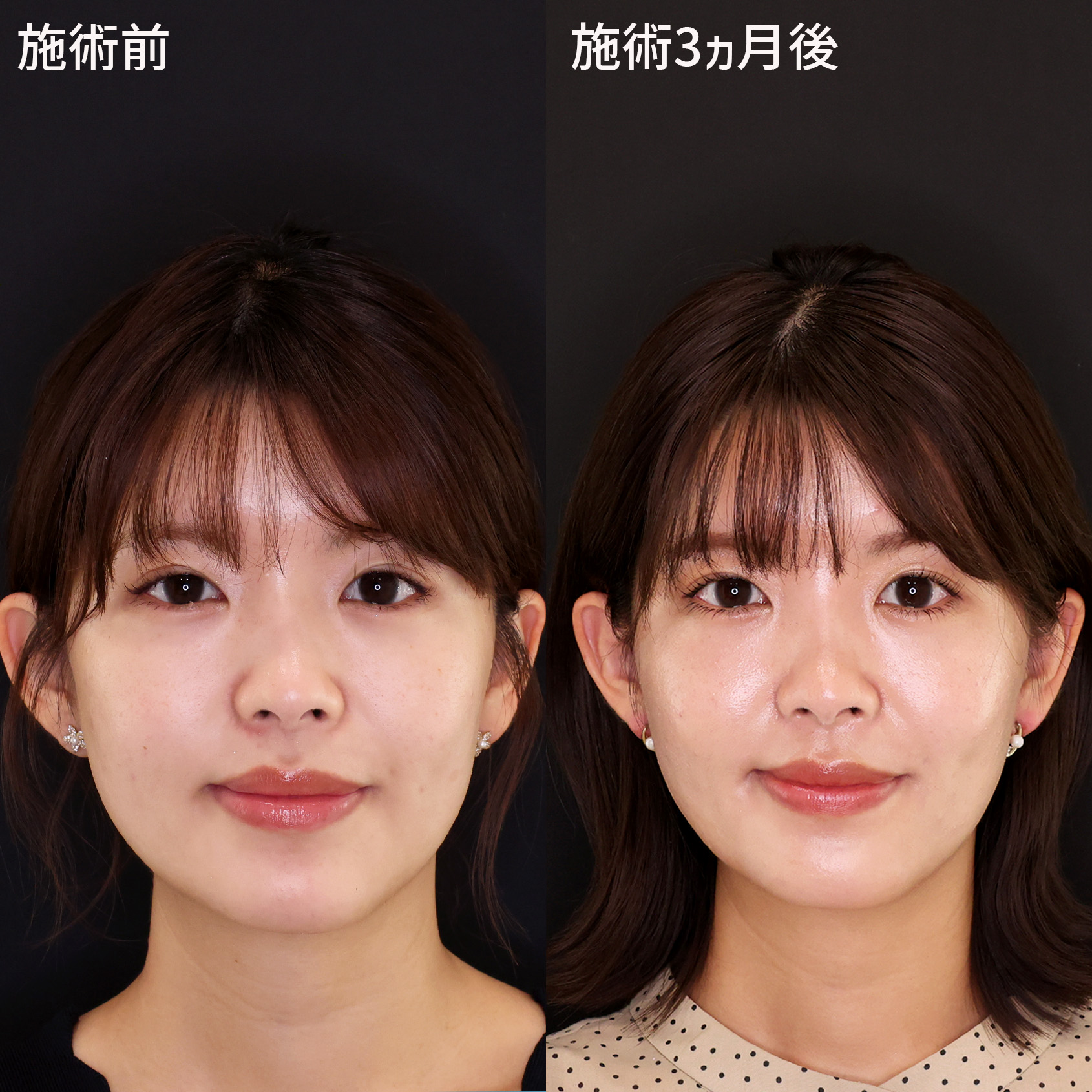 TAC式 ツヤ肌コラーゲンリフト®/顔の脂肪吸引/ジョールファット除去の症例写真 施術前後 