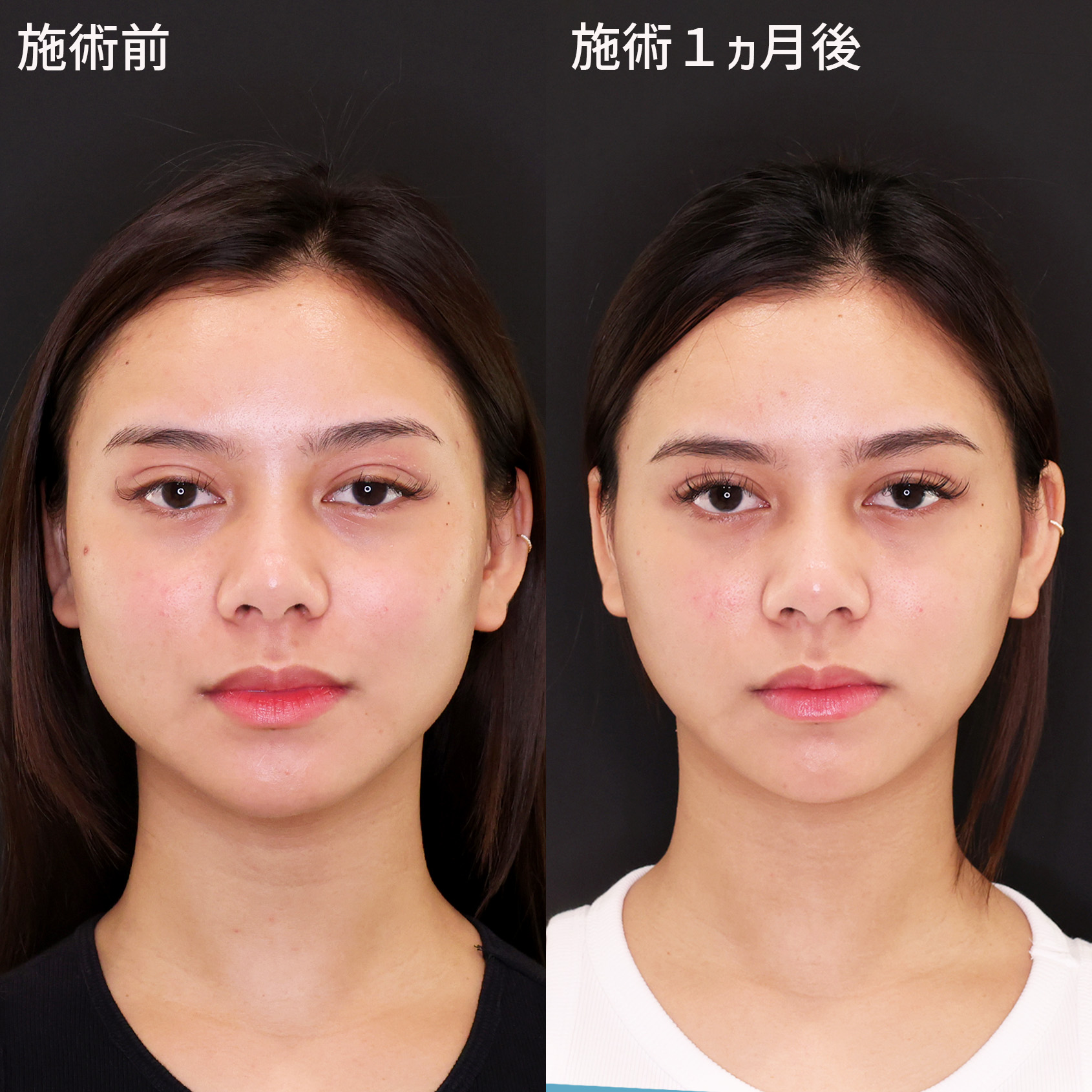 【糸リフト＋脂肪除去】で美しい理想のフェイスラインへ