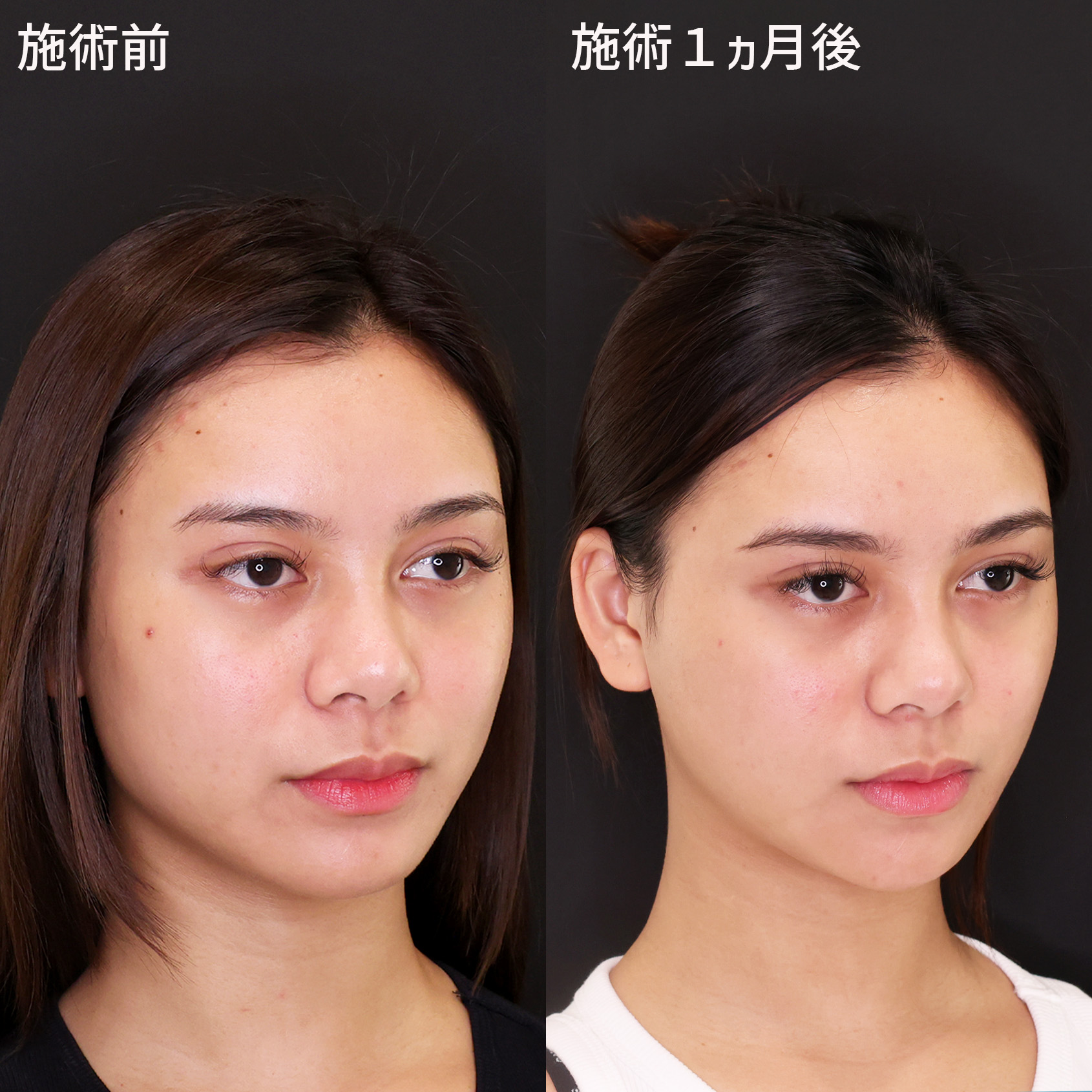 TAC式 ツヤ肌コラーゲンリフト®/ジョールファット除去/エラボトックス注射の症例写真 施術前後 