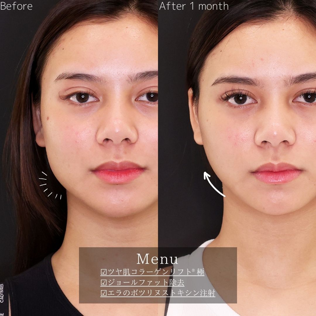 TAC式 ツヤ肌コラーゲンリフト®/ジョールファット除去/エラボトックス注射の症例写真 施術前後 