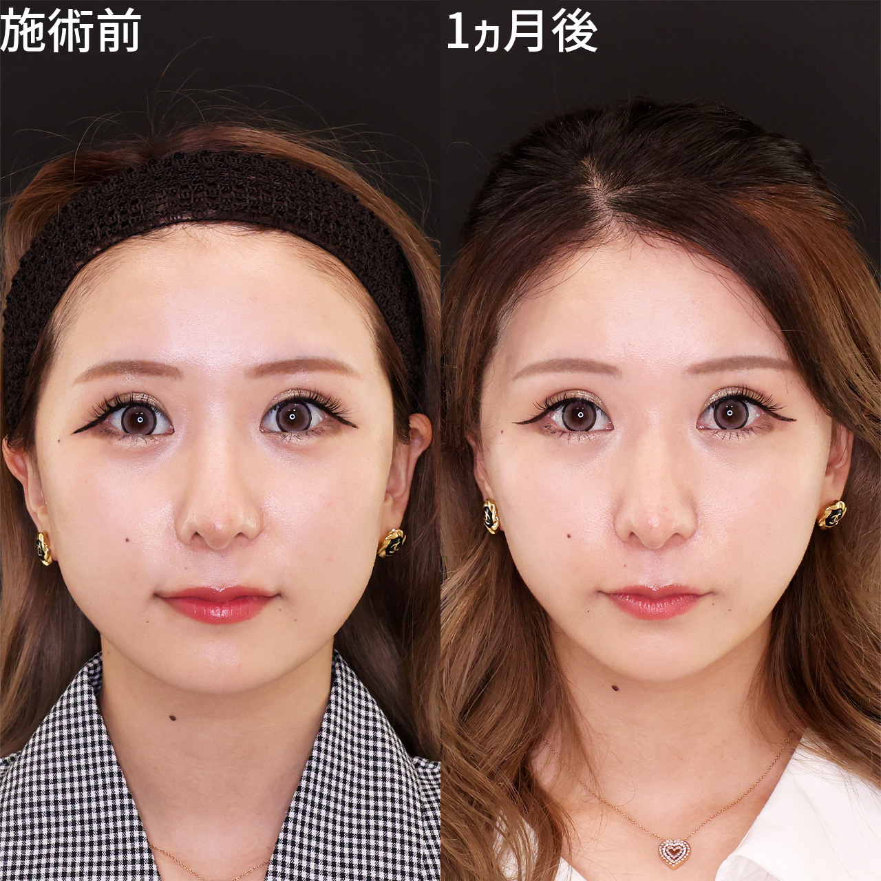 【小顔複合施術】でどの角度から見てもすっきり！美しい輪郭へ♪