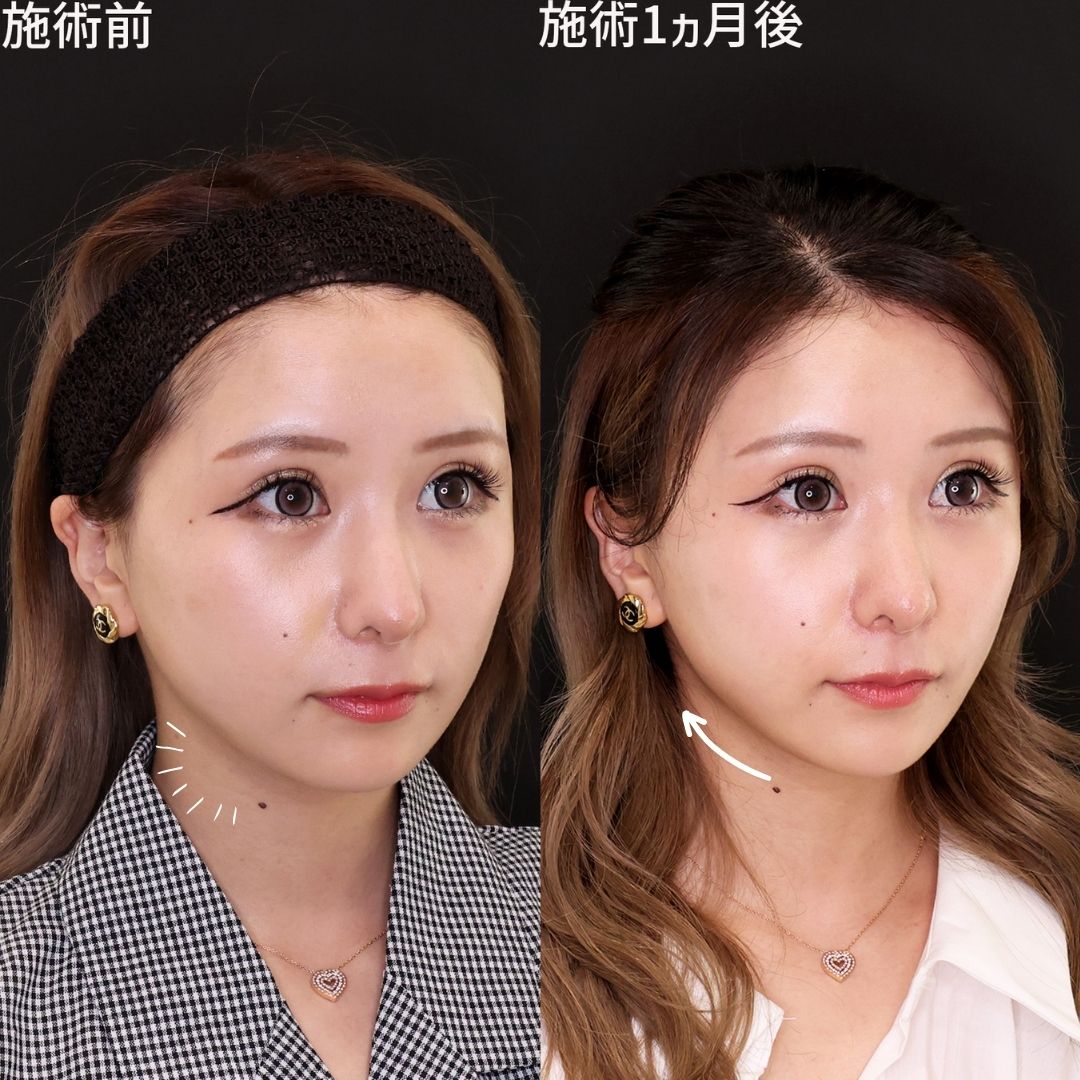 小顔整形｜パーフェクトフェイスライン/TAC式 ツヤ肌コラーゲンリフト®/ジョールファット除去の症例写真 施術前後 