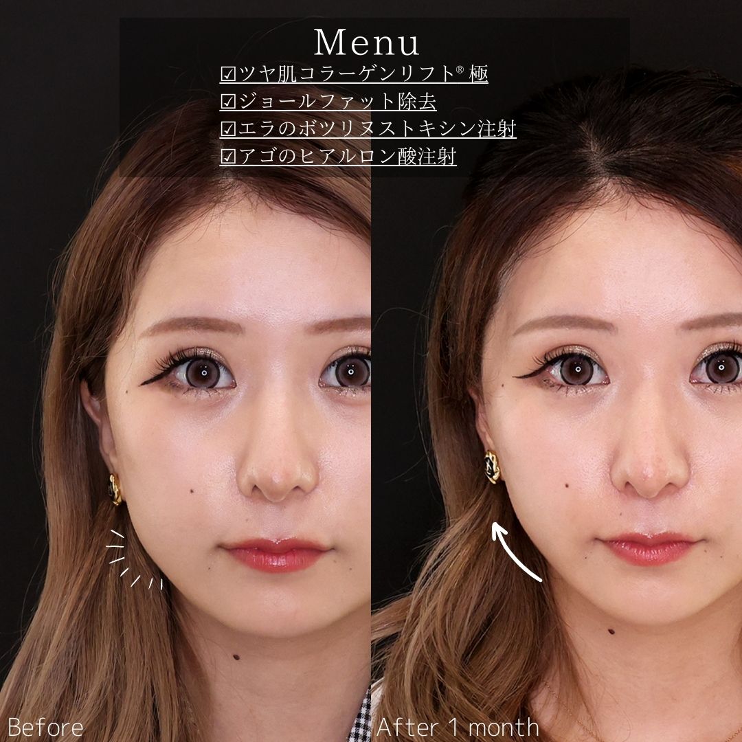 小顔整形｜パーフェクトフェイスライン/TAC式 ツヤ肌コラーゲンリフト®/ジョールファット除去の症例写真 施術前後 