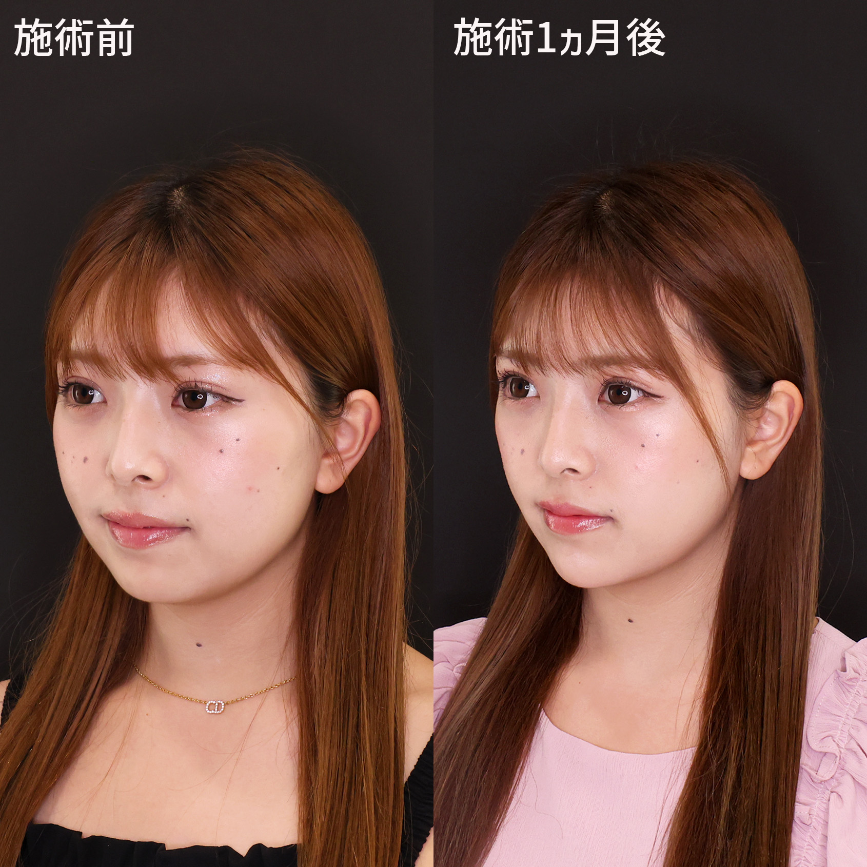 小顔整形｜パーフェクトフェイスラインの症例写真 施術前後 