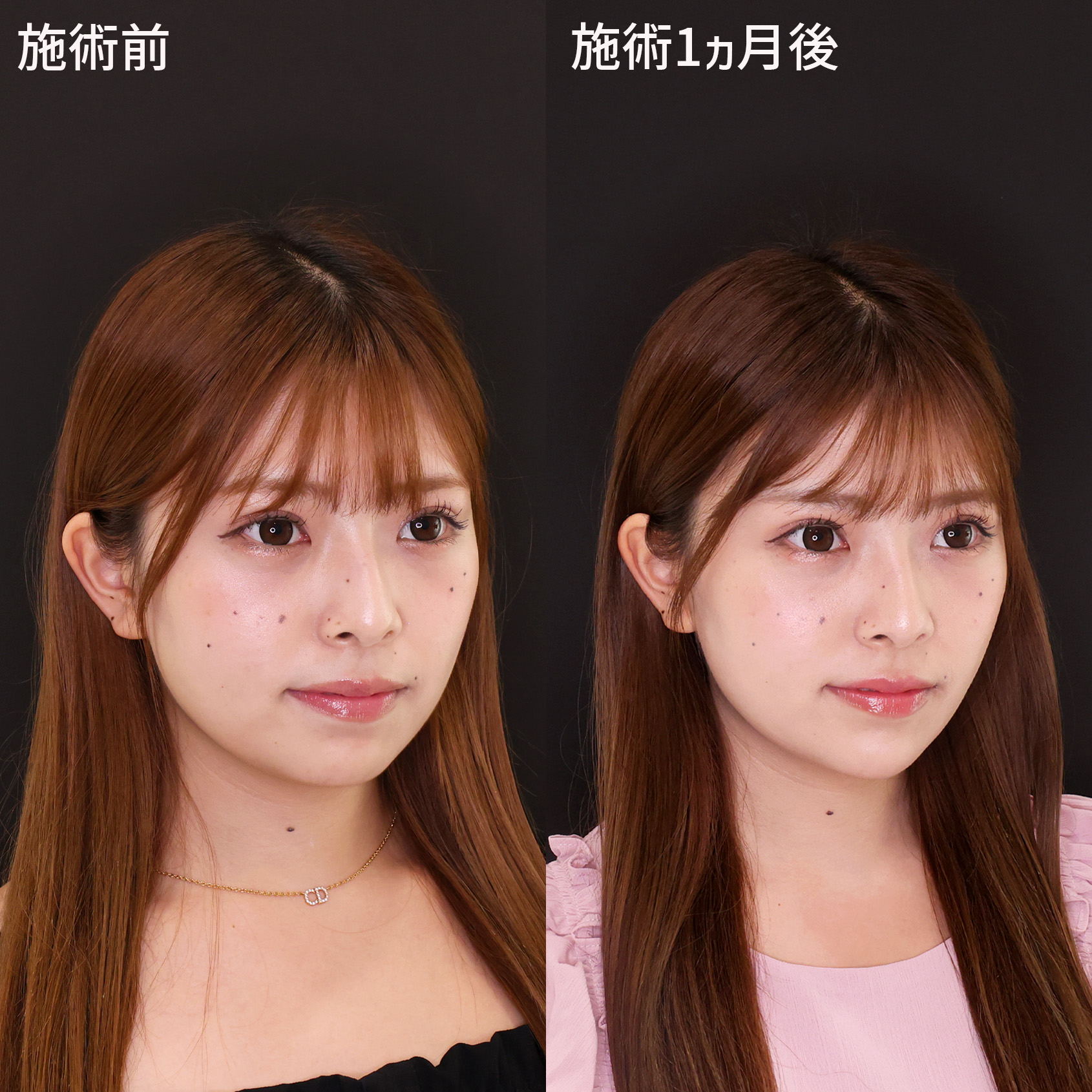 小顔整形｜パーフェクトフェイスラインの症例写真 施術前後 