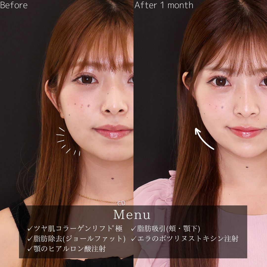 小顔整形｜パーフェクトフェイスラインの症例写真 施術前後 
