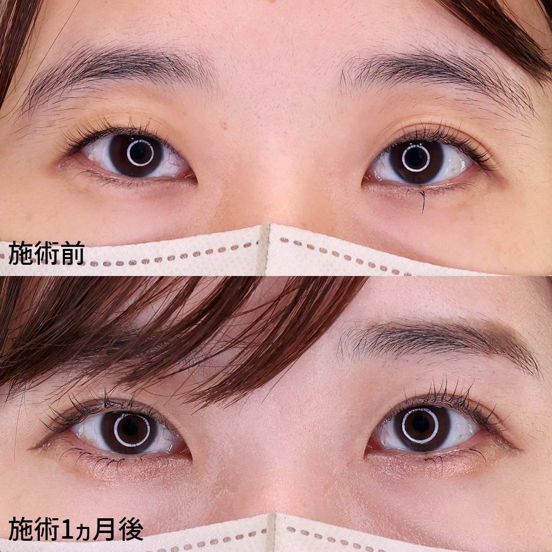 二重埋没法の症例写真 施術前後