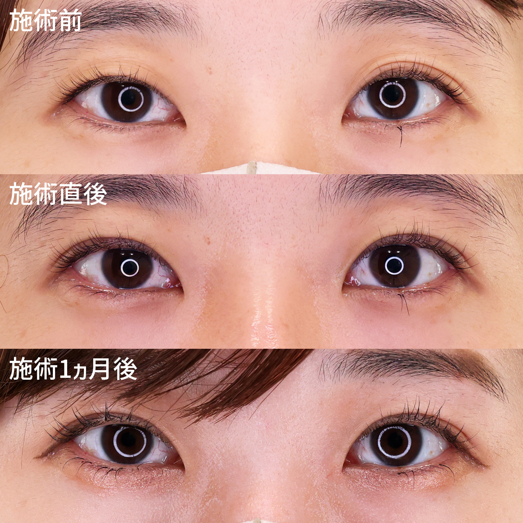 二重埋没法の症例写真 施術前後