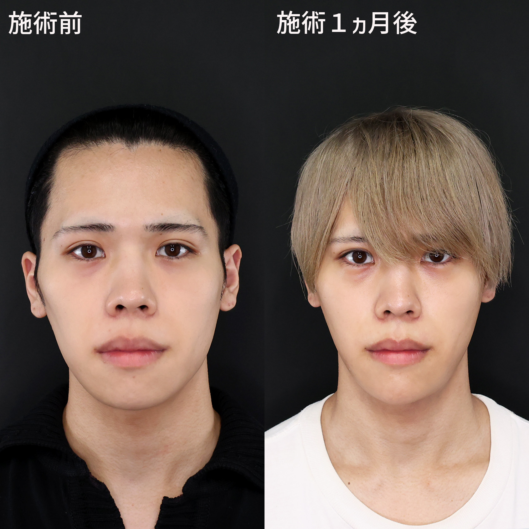 Eラインを整えながら、もたつきゼロのイケメン小顔へ【糸リフト＋脂肪除去】