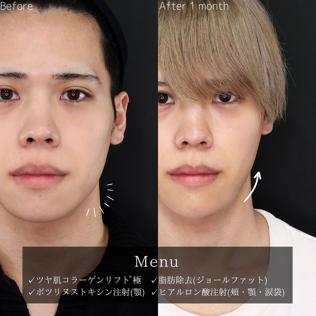 TAC式 ツヤ肌コラーゲンリフト®/ジョールファット除去/ボトックス注射：その他の症例写真 施術前後 