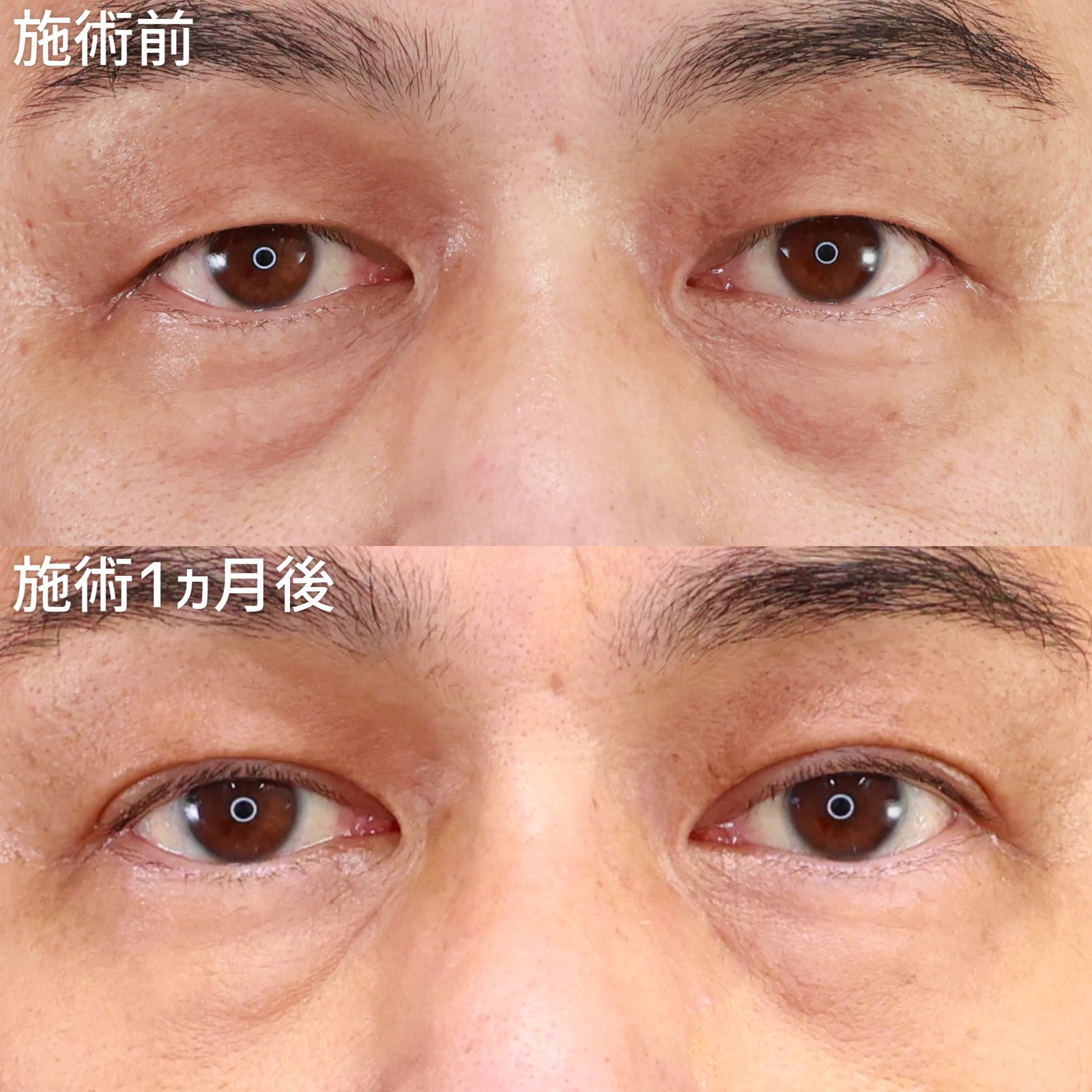 二重埋没法の症例写真 施術前後