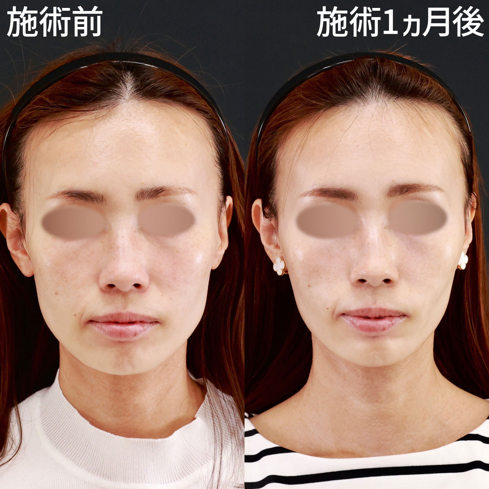 【糸リフト＆小顔注射】短いダウンタイムでお顔を小さく！