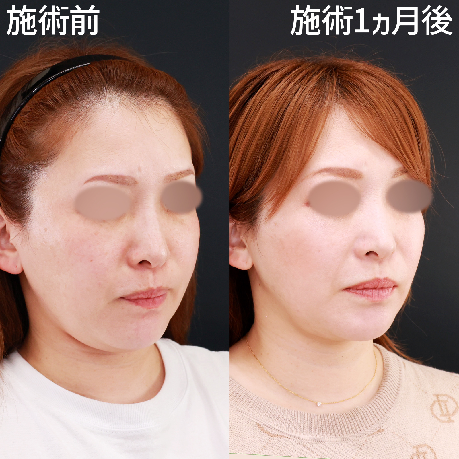 TAC式 ツヤ肌コラーゲンリフト®/ほうれい線のヒアルロン酸注射/顔の脂肪吸引の症例写真 施術前後 