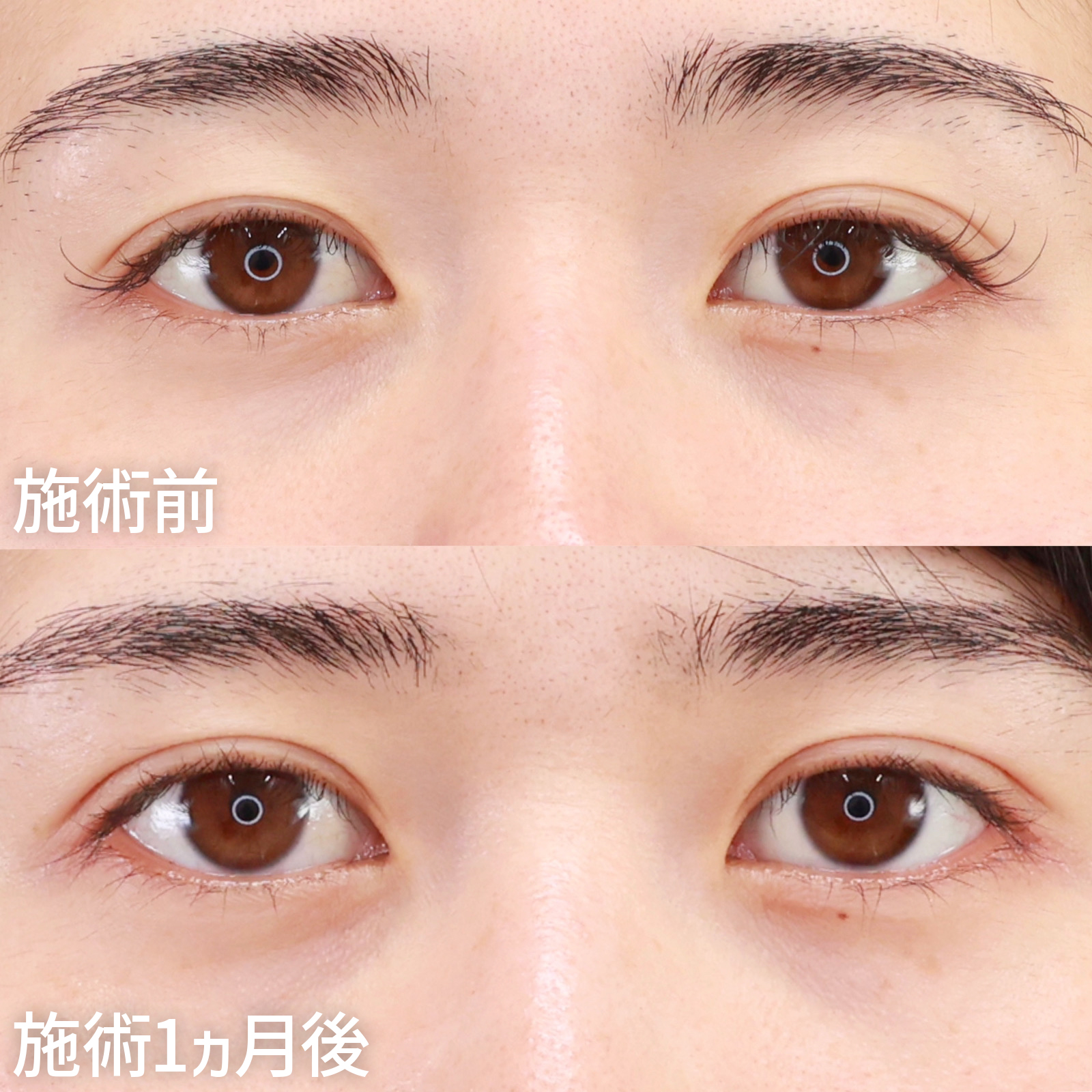 【二重埋没法】ほんの少しの左右差をバッチリ合わせる！