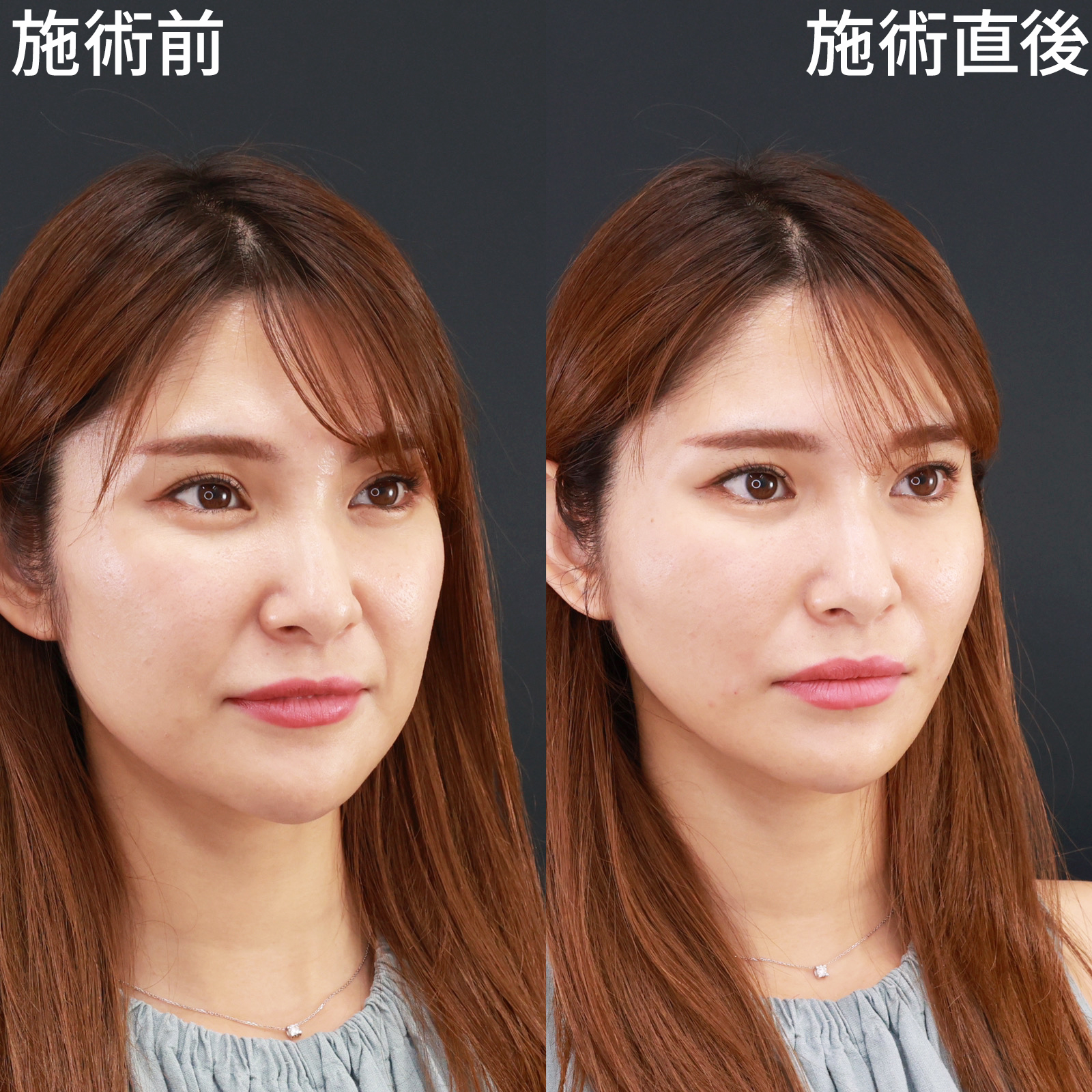 ほうれい線のヒアルロン酸注射/TAC式 ツヤ肌コラーゲンリフト®の症例写真 施術前後 