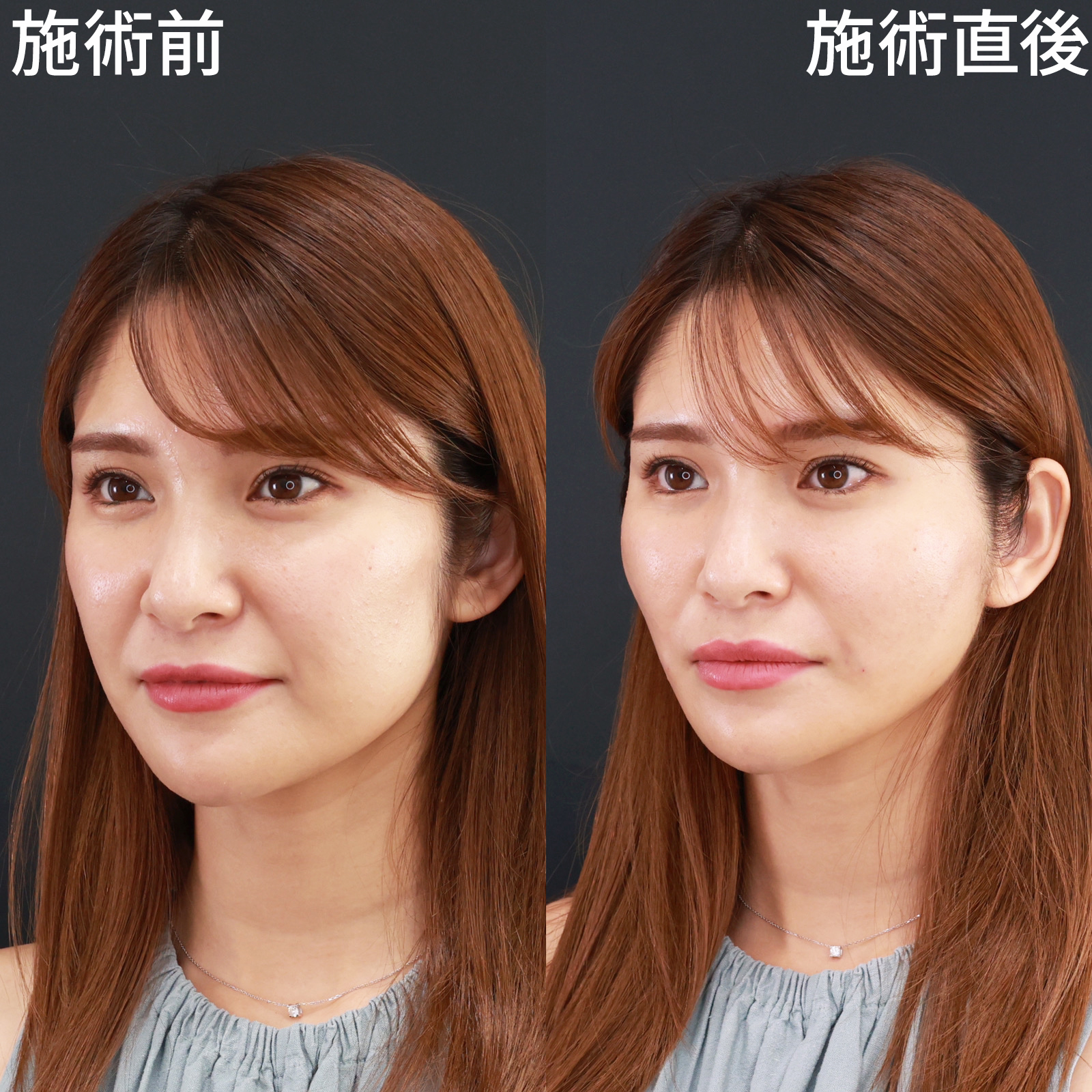 ほうれい線のヒアルロン酸注射/TAC式 ツヤ肌コラーゲンリフト®の症例写真 施術前後 