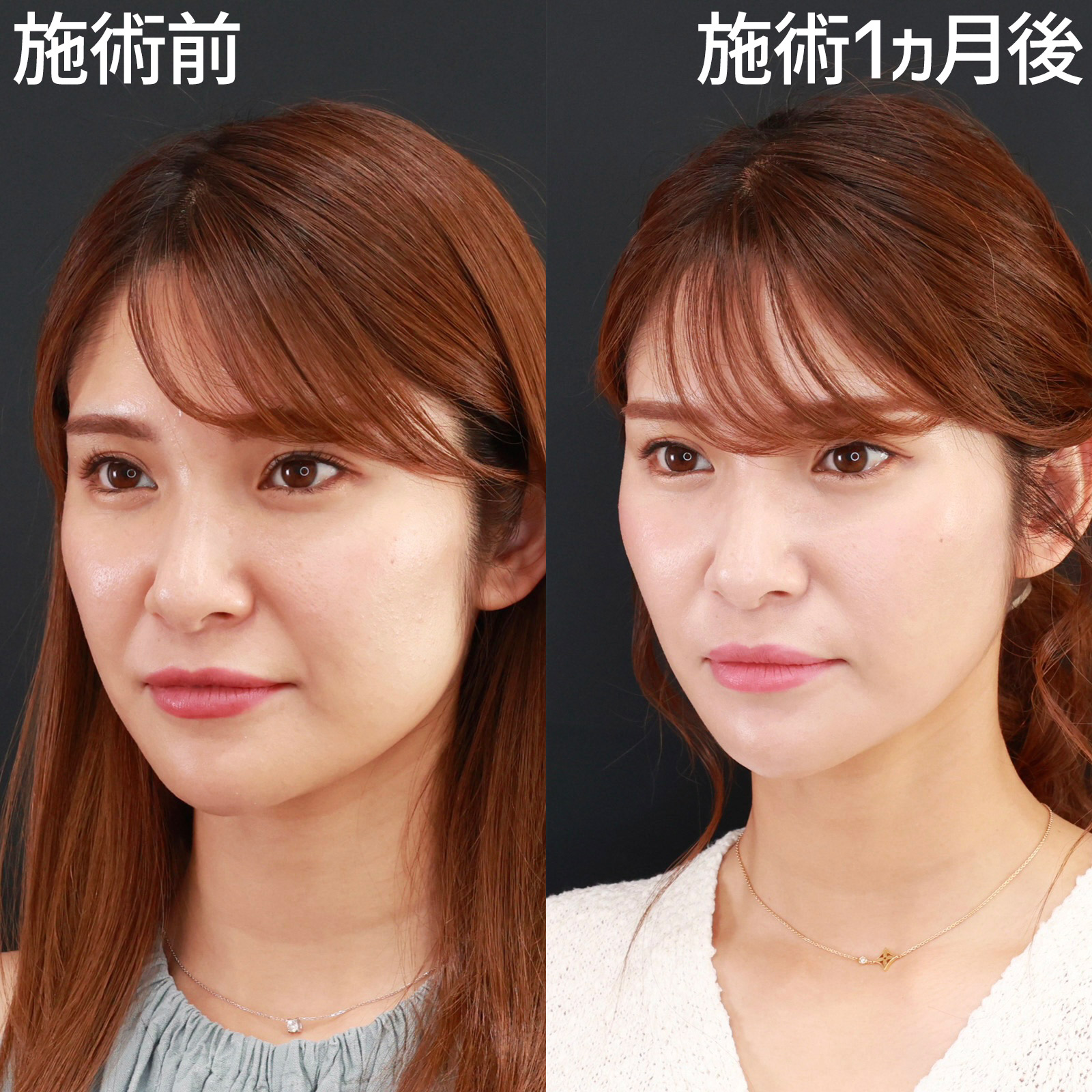 ほうれい線のヒアルロン酸注射/TAC式 ツヤ肌コラーゲンリフト®の症例写真 施術前後 