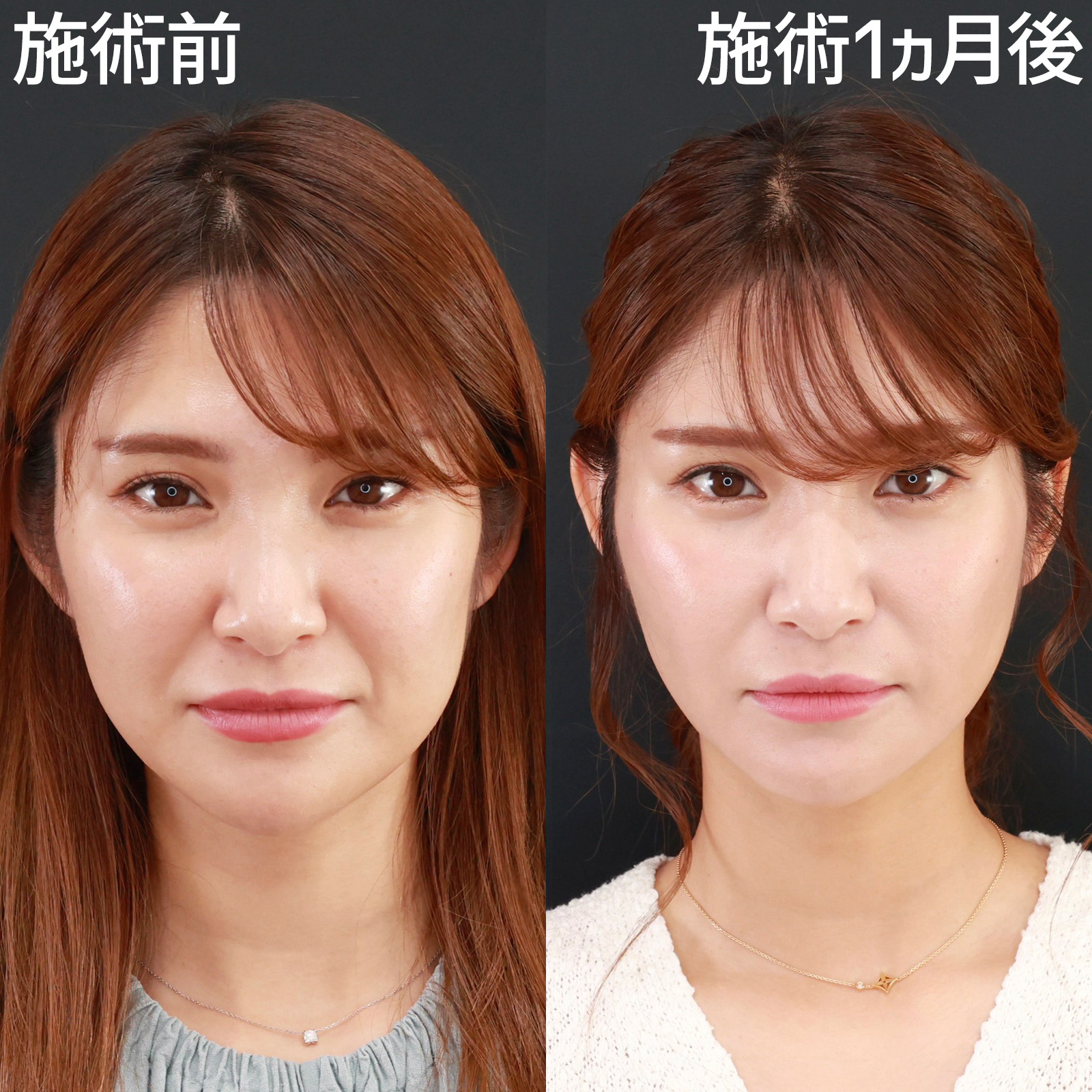 ほうれい線のヒアルロン酸注射/TAC式 ツヤ肌コラーゲンリフト®の症例写真 施術前後 