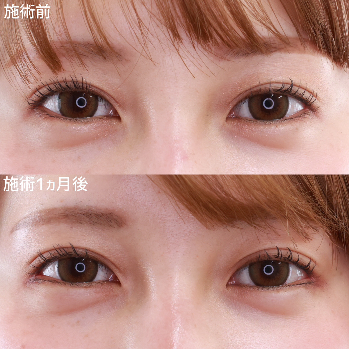 【タレ目尻切開】自然な仕上がりで目元の印象を変える