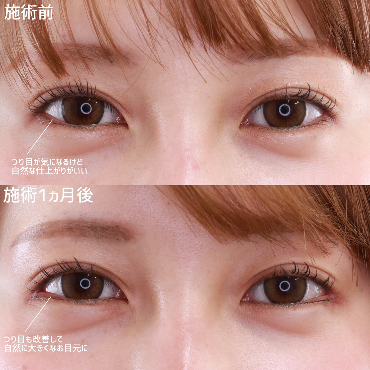 目尻切開術/目尻靭帯移動術の症例写真 施術前後 