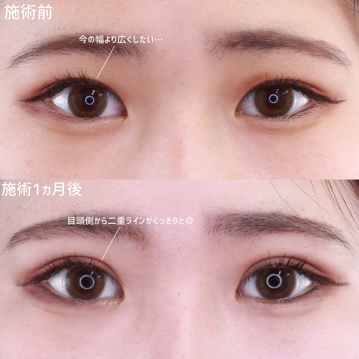 二重埋没法/目元：その他の症例写真 施術前後 