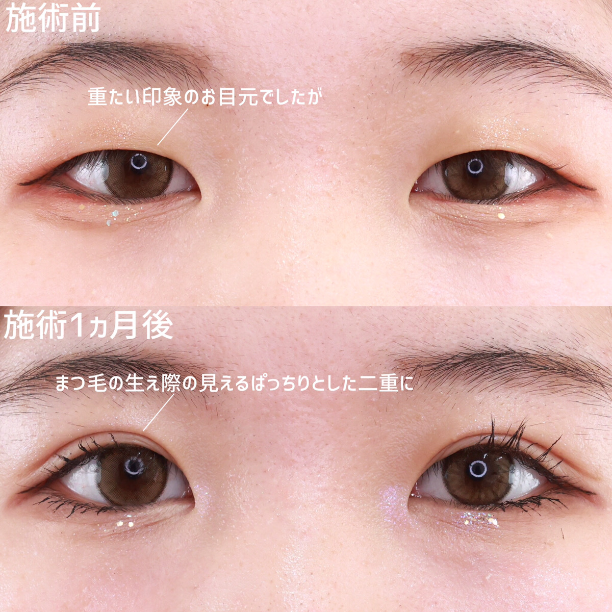 二重埋没法の症例写真 施術前後 