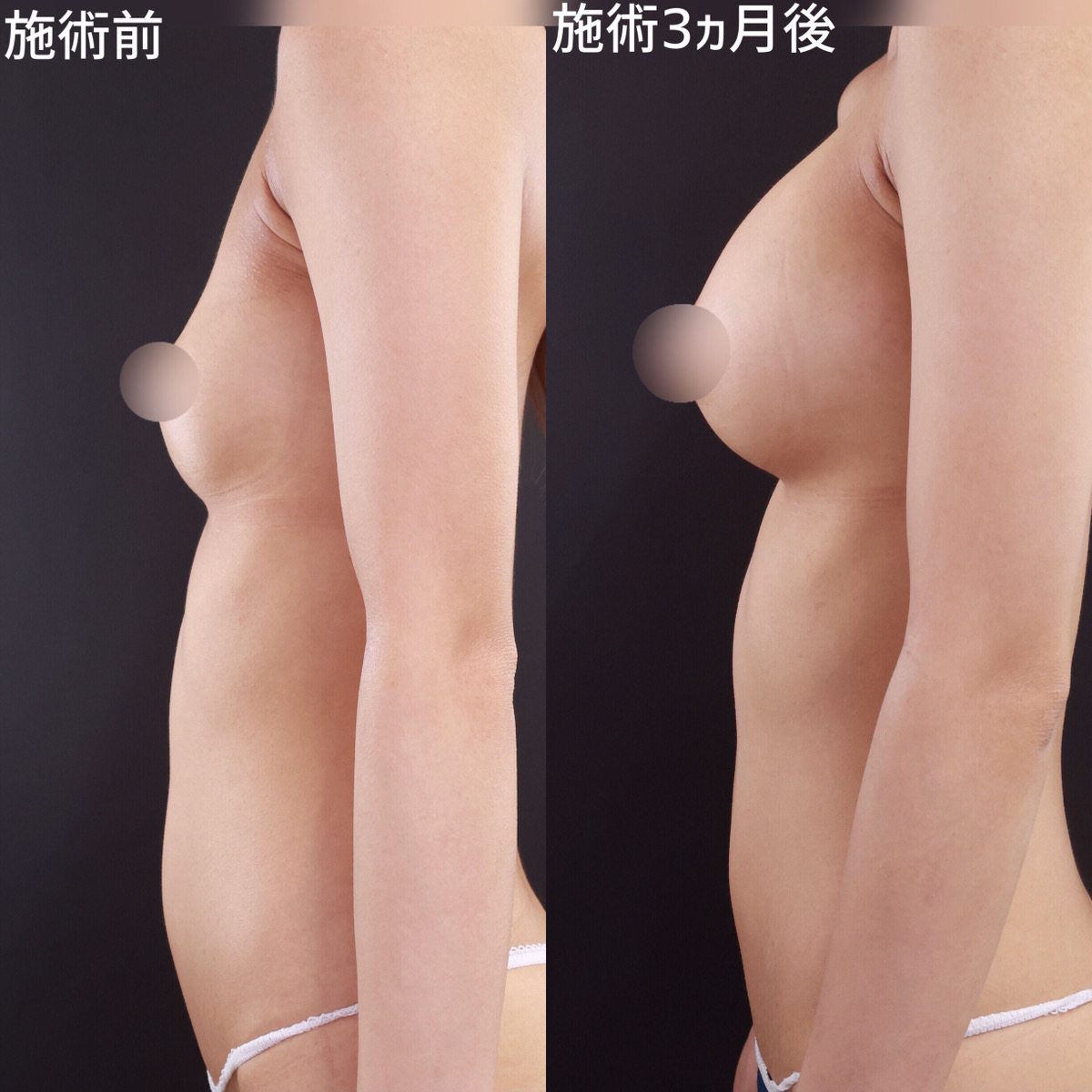 シリコンバッグ豊胸（人工乳腺バッグ）の症例写真 施術前後 