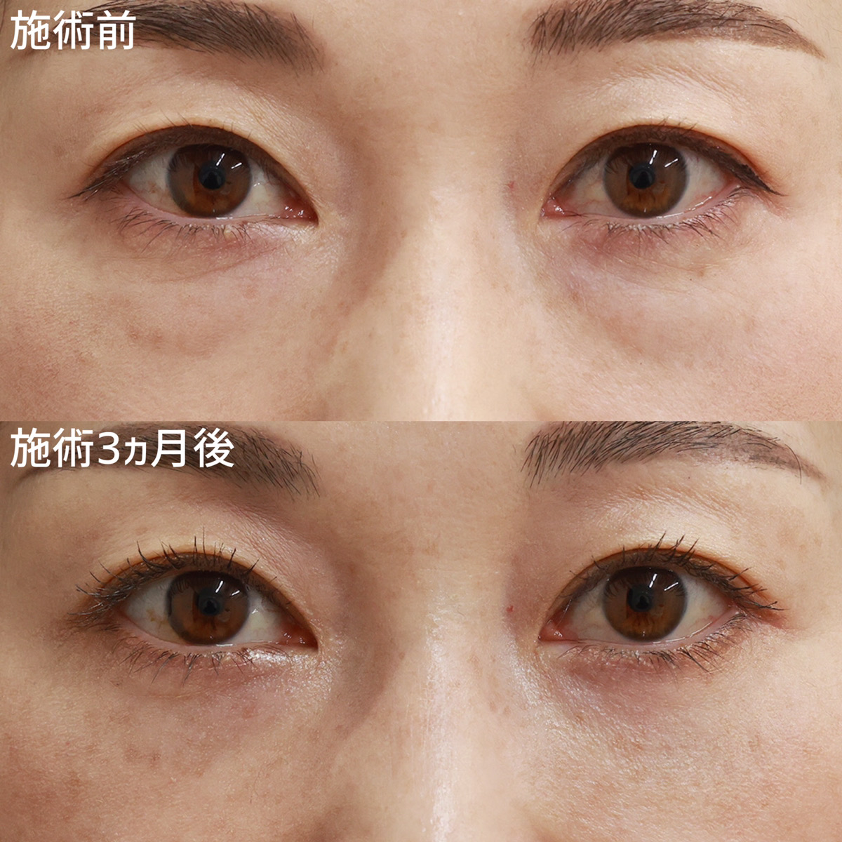 【目の下のたるみ取り】－〇〇歳？あの頃の私の目元に