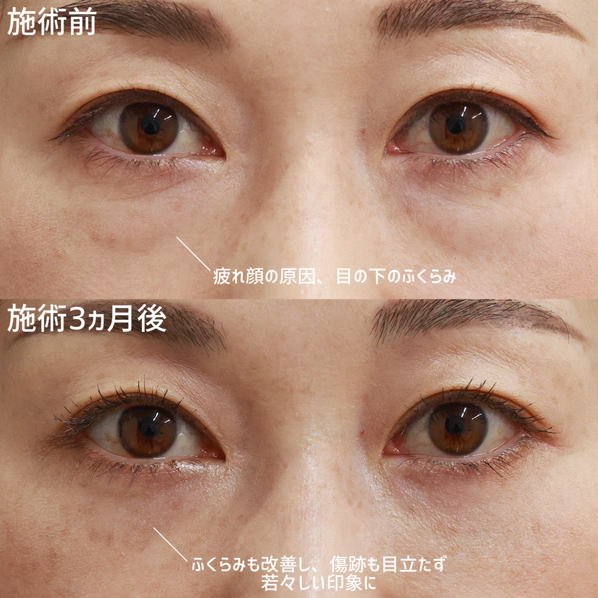 下眼瞼切開術（クマ・たるみとり）/下眼瞼脱脂術（目の下のたるみ取り・目の下の脂肪ふくらみ取り）/顔の脂肪注入(コンデンスリッチフェイス)の症例写真 施術前後 