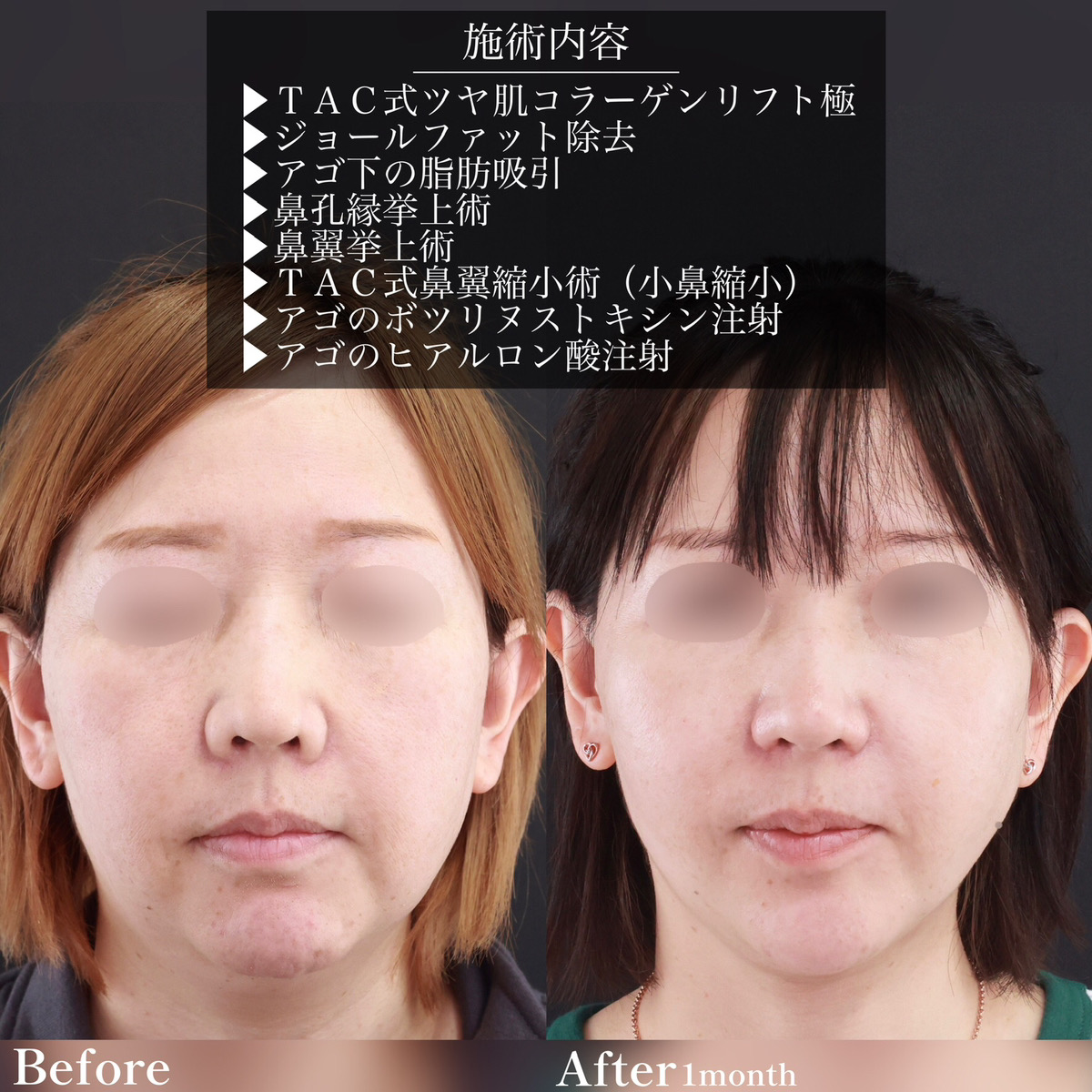 鼻孔縁挙上術/鼻翼挙上術/TAC式 鼻翼縮小術（小鼻縮小）の症例写真 施術前後 