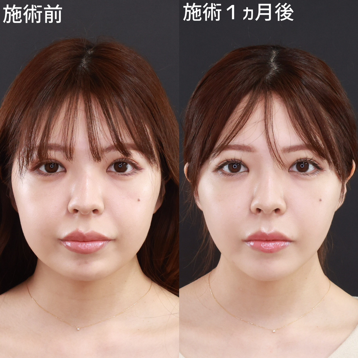 【パーフェクトフェイスライン】で加工アプリがいらない小顔に