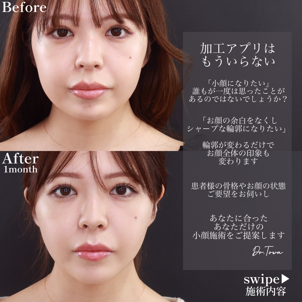 小顔整形｜パーフェクトフェイスライン/ヒアルロン酸注射：その他/顎のヒアルロン酸注射の症例写真 施術前後 