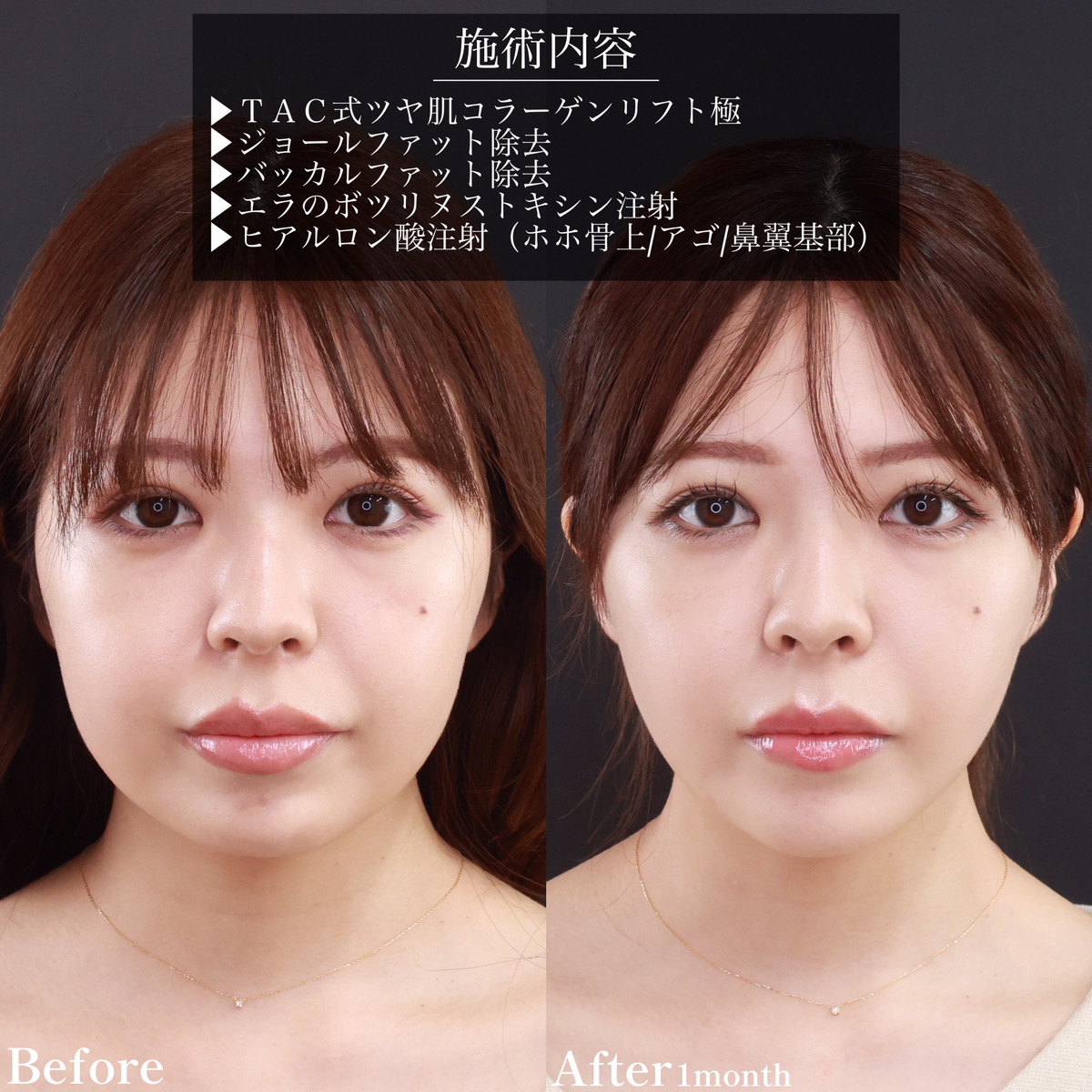 小顔整形｜パーフェクトフェイスライン/ヒアルロン酸注射：その他/顎のヒアルロン酸注射の症例写真 施術前後 