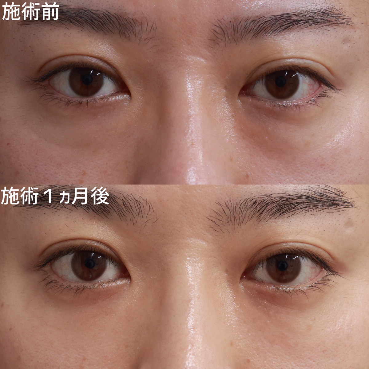 【裏ハムラ法】眼窩脂肪を移動させ、目の下のふくらみ・凹みを改善！