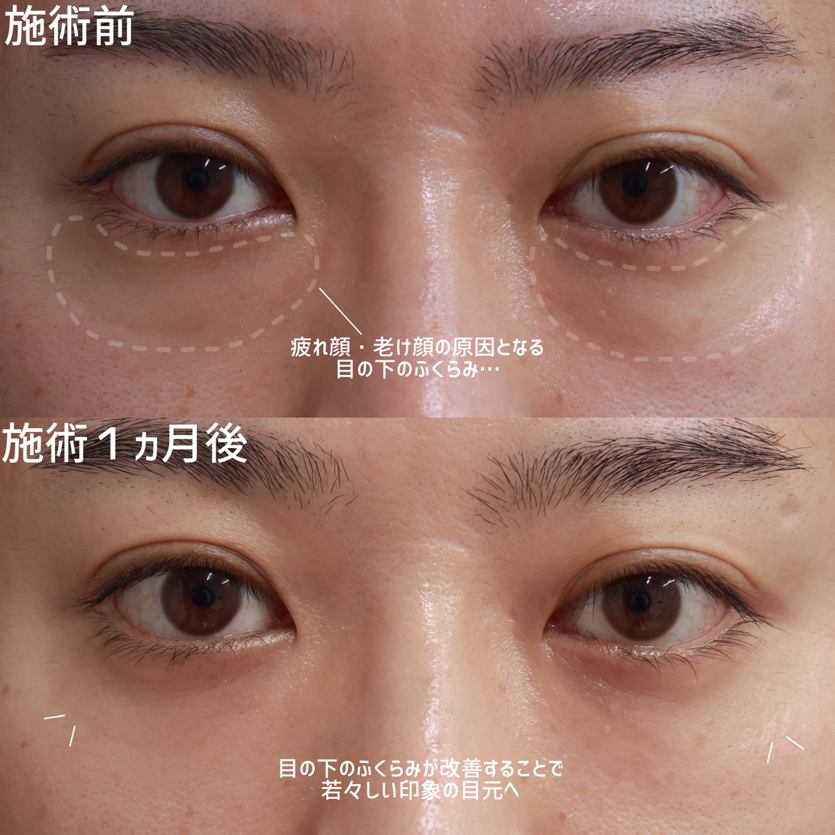 下眼瞼脱脂術（目の下のたるみ取り・目の下の脂肪ふくらみ取り）の症例写真 施術前後 