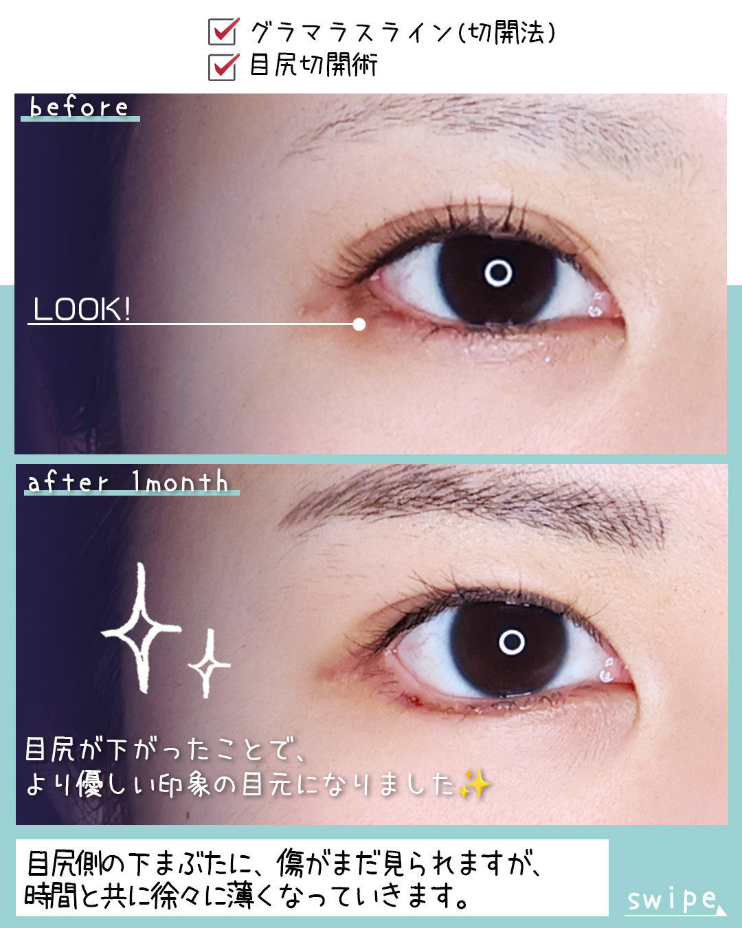 グラマラスライン（タレ目形成）/目尻切開術の症例写真 施術前後 