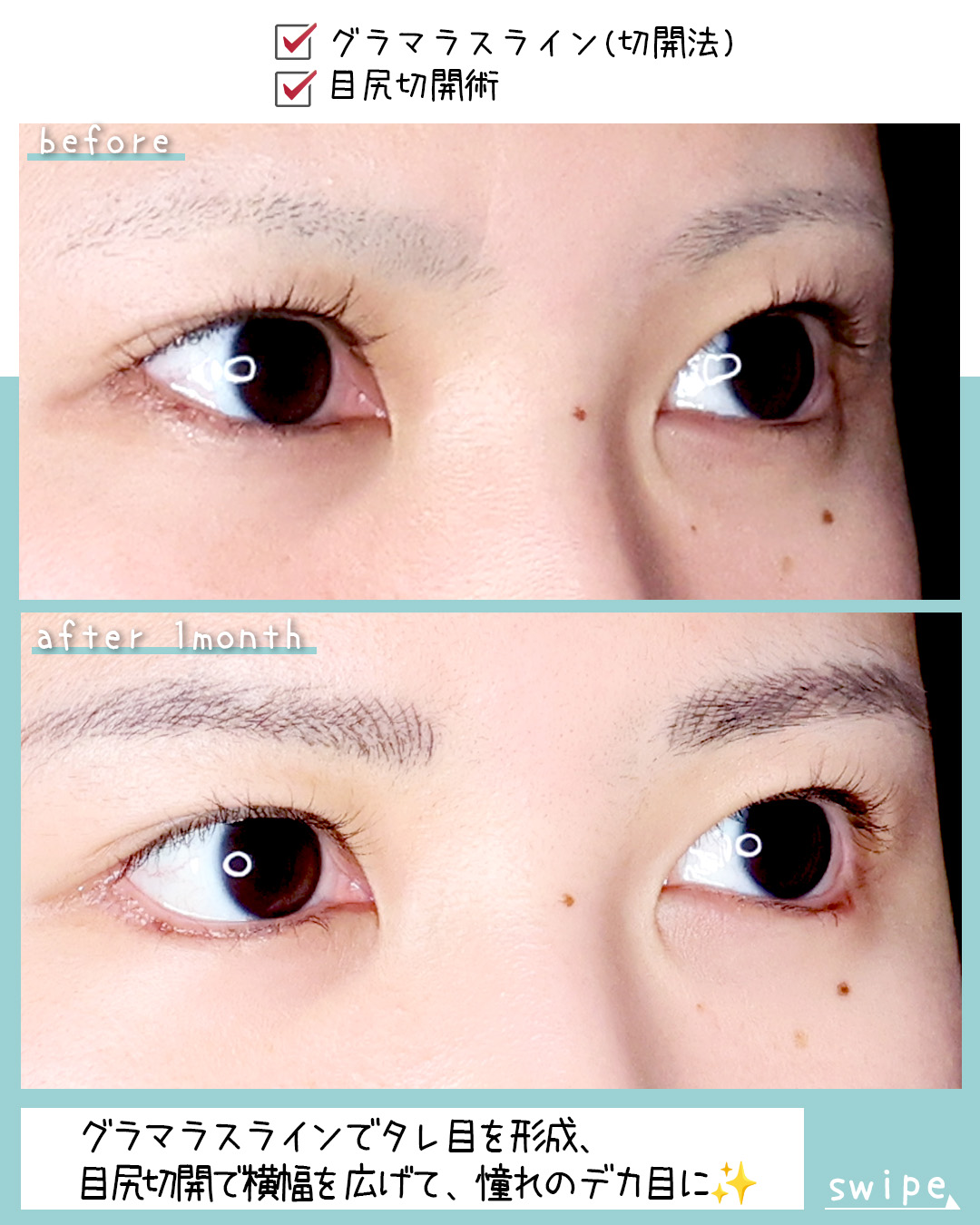 グラマラスライン（タレ目形成）/目尻切開術の症例写真 施術前後 