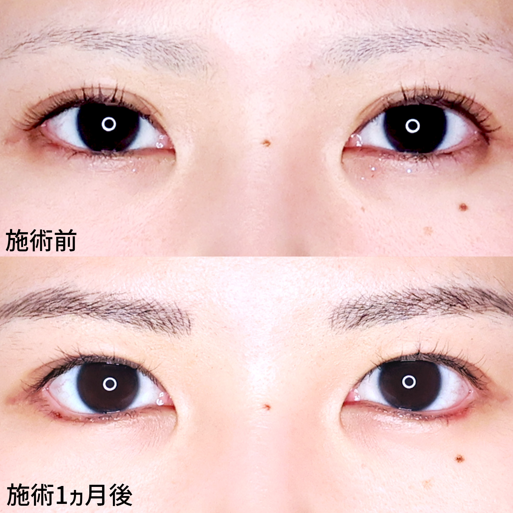 【目尻切開術】可愛くデカ目に！【タレ目形成】