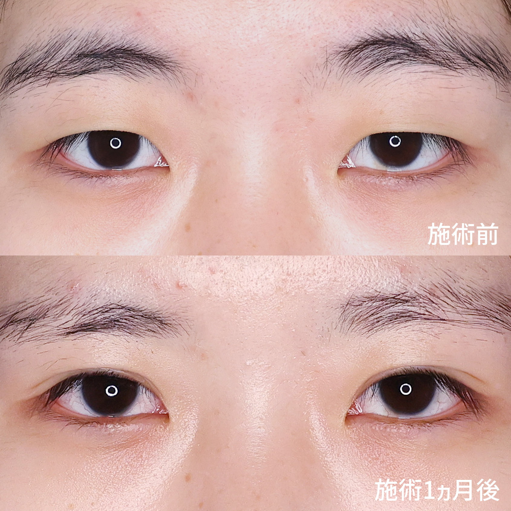 二重埋没法の症例写真 施術前後