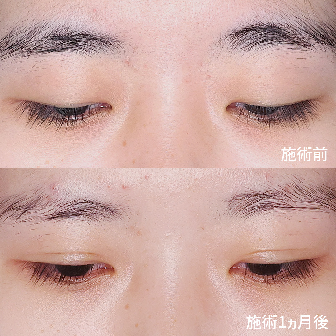 二重埋没法の症例写真 施術前後