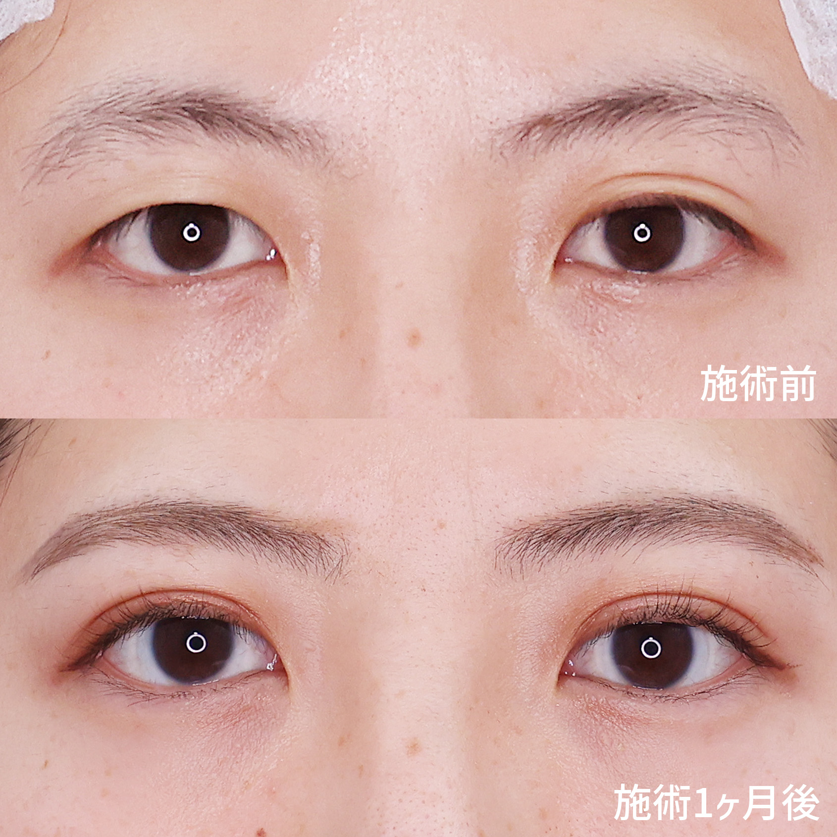 二重埋没法の症例写真 施術前後