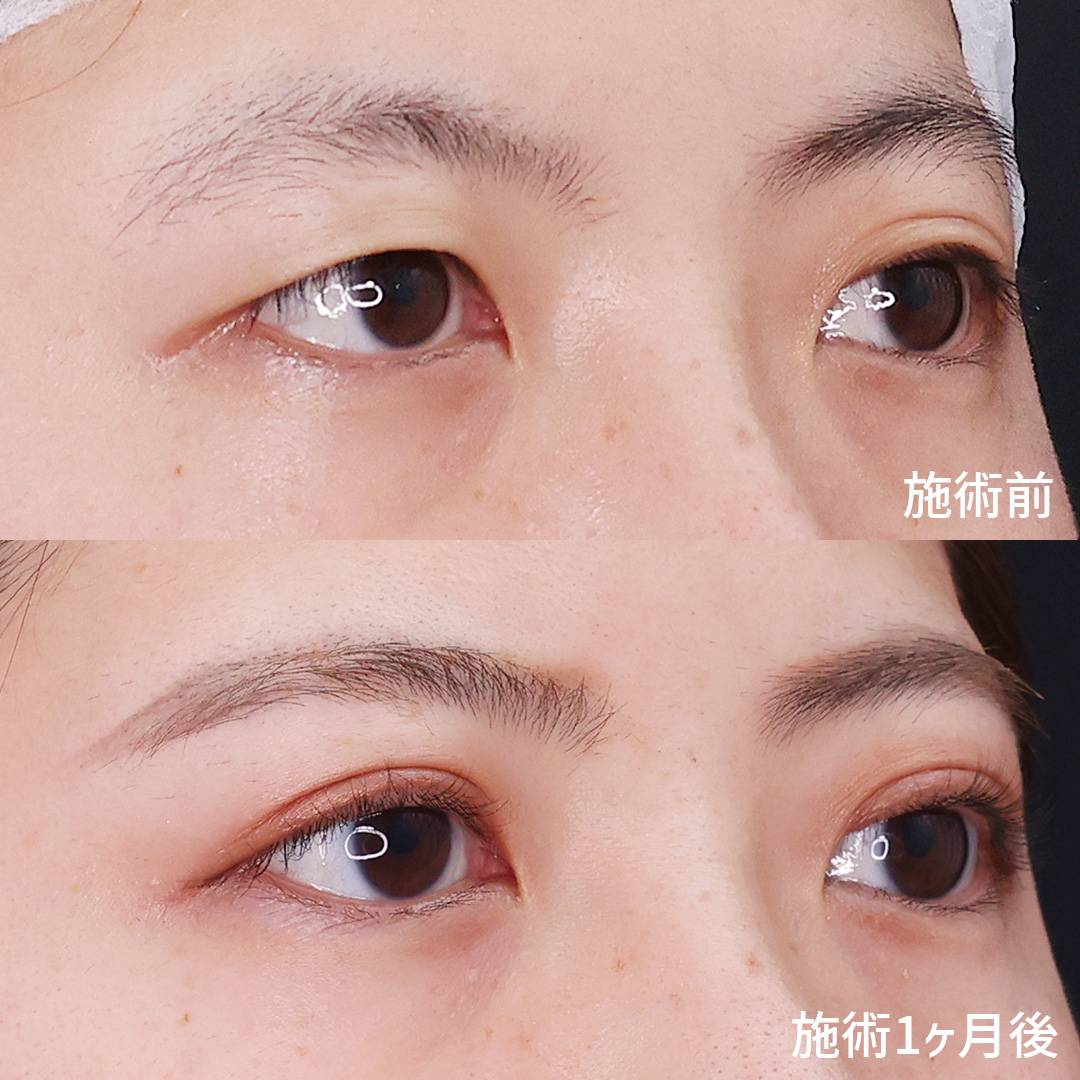 二重埋没法の症例写真 施術前後