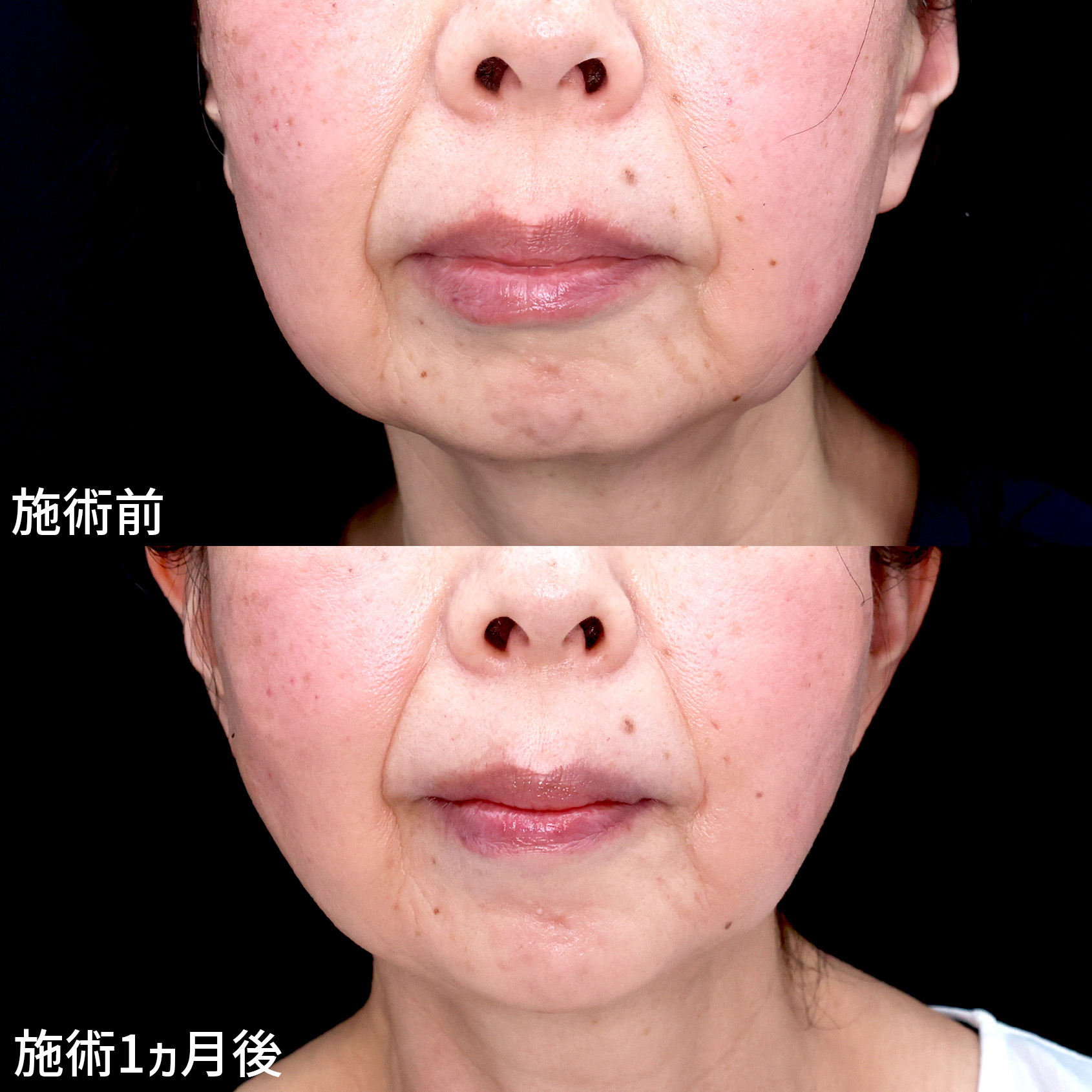 四角い輪郭から脱却！　糸リフトで顔の形を美しく整え！！