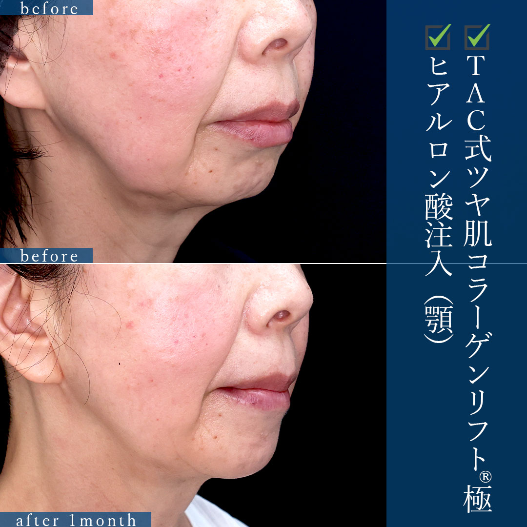 TAC式 ツヤ肌コラーゲンリフト®/顎のヒアルロン酸注射の症例写真 施術前後 