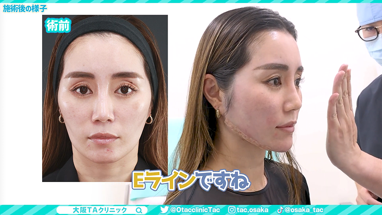 術前写真と並べて施術直後の横顔のEラインを確認する様子