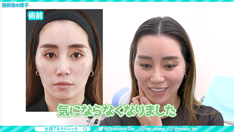 術前写真と並べて施術直後の頬のこけを確認する患者様