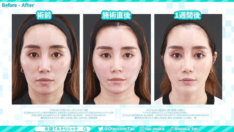 糸リフトとヒアルロン酸注入の術前・施術直後・1週間後の正面写真