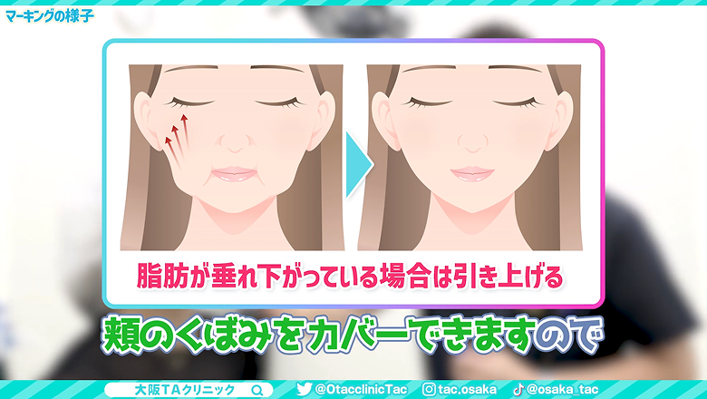 垂れ下がった頬の脂肪を糸で引き上げる変化を示したイラスト