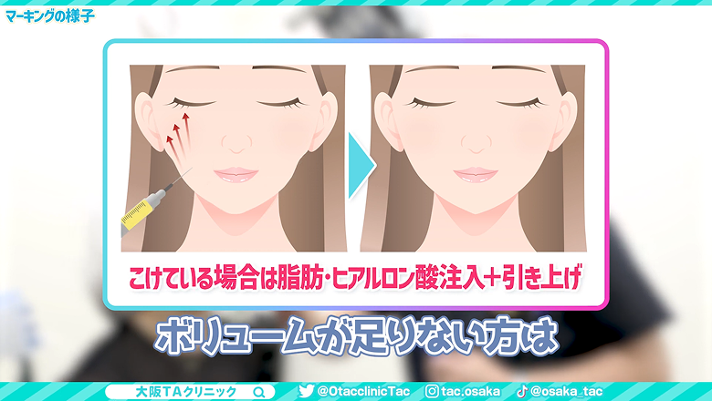 こけた頬に脂肪やヒアルロン酸を注入して引き上げるイラスト
